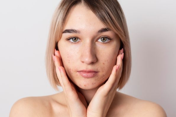Acne - Pure Saron
